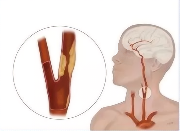 超千万中国人体检结果：两成有颈动脉斑块